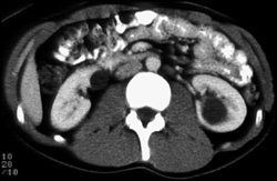 Left Cystic Renal Cell Carcinoma - CTisus CT Scan