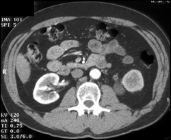 Stone in Proximal Left Ureter - CTisus CT Scan