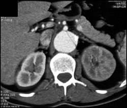 Aortic Dissection With Decreased Flow to Left Kidney - CTisus CT Scan