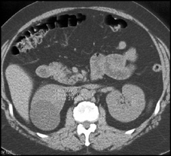 Renal Cyst - CTisus CT Scan