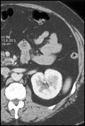 Renal Cyst - CTisus CT Scan