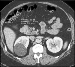 Renal Cyst - CTisus CT Scan