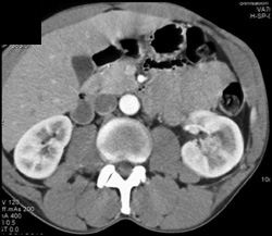 2 Cm Renal Cell Carcinoma - CTisus CT Scan