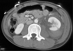 Renal Laceration - CTisus CT Scan