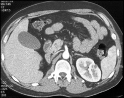 Old Renal Infarct - CTisus CT Scan