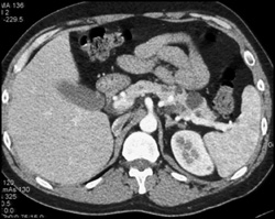 Renal and Pancreatic Cysts - CTisus CT Scan