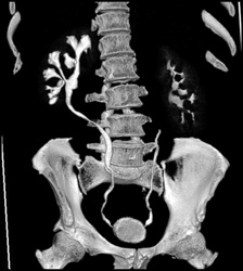 Dilated Right Renal Pelvis - CTisus CT Scan