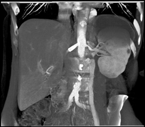 Stent in Right Renal Artery - CTisus CT Scan