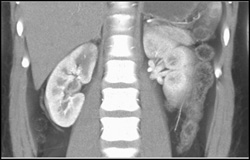 Right Renal Pyelonephritis - CTisus CT Scan