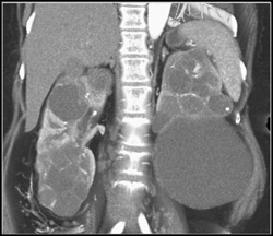 Cystic Renal Cell Carcinoma and Cysts - CTisus CT Scan