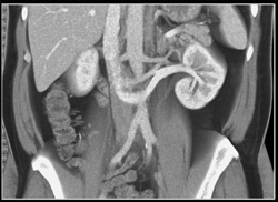 Retroaortic Left Renal Vein - CTisus CT Scan