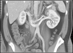 Retroaortic Left Renal Vein - CTisus CT Scan