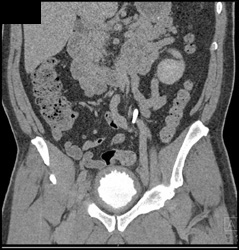 Bladder Cancer - CTisus CT Scan