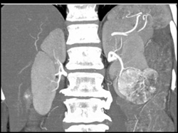 Renal Cell Carcinoma - CTisus CT Scan