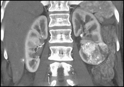 Renal Cell Carcinoma - CTisus CT Scan