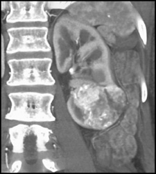 Renal Cell Carcinoma - CTisus CT Scan