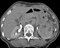 Renal Cell Carcinoma - CTisus CT Scan