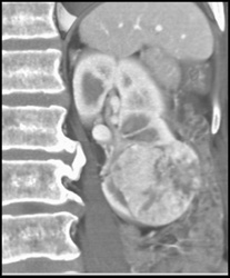 Renal Cell Carcinoma - CTisus CT Scan