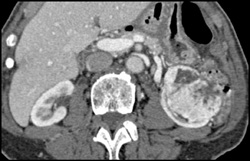 Renal Cell Carcinoma - CTisus CT Scan