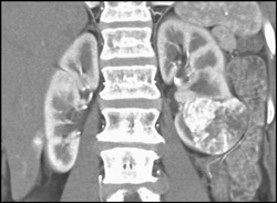 Renal Cell Carcinoma - CTisus CT Scan