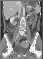 Right Renal Angiomyolipoma (AML) - CTisus CT Scan