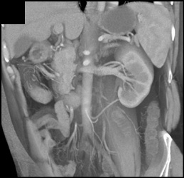 2 Left Renal Arteries - CTisus CT Scan