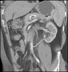 2 Left Renal Arteries - CTisus CT Scan