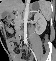 Prehilar Branching and 2 Left Renal Arteries - CTisus CT Scan