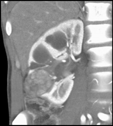 Renal Cell Carcinoma - CTisus CT Scan