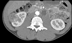 Renal Cell Carcinoma - CTisus CT Scan