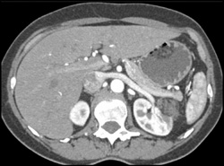 Post Rf Left Kidney - CTisus CT Scan