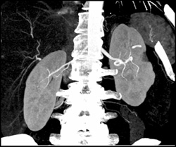 Post Radiofrequency Ablation (RFA) - CTisus CT Scan