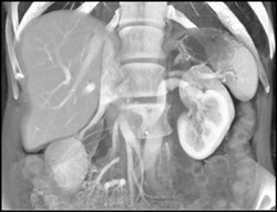 Retroaortic Renal Vein - CTisus CT Scan