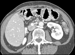 Retroaortic Renal Vein - CTisus CT Scan