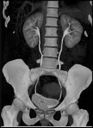 Normal CT Urogram - CTisus CT Scan