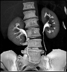 Normal CT Urogram - CTisus CT Scan