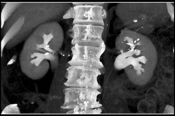 Normal CT Urogram - CTisus CT Scan