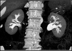 Normal CT Urogram - CTisus CT Scan