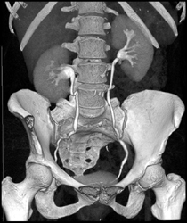 Normal CT Urogram - CTisus CT Scan