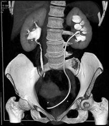 Stent in Hydronephrotic Left Kidney - CTisus CT Scan