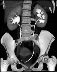 Nice CT Urogram With Dilated Calyces on Left - CTisus CT Scan