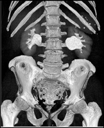 Dilated Renal Pelvises Bilaterally - CTisus CT Scan