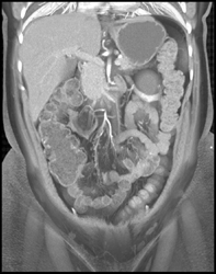 Ureteropelvic Junction (UPJ) on the Left Due to Crossing Lower Pole Artery - CTisus CT Scan