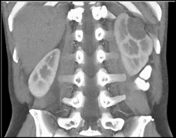 Renal Cystic Tumor - CTisus CT Scan