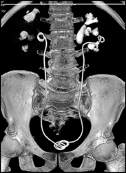 Bilateral Stents in Place - CTisus CT Scan