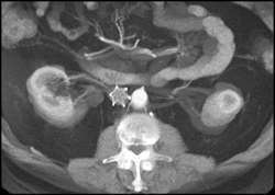 Right Renal Artery Aneurysm - CTisus CT Scan