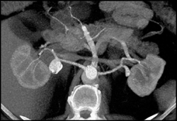 Right Renal Artery Aneurysm - CTisus CT Scan