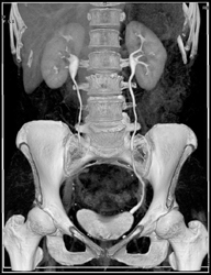 Ct Urogram Normal - CTisus CT Scan