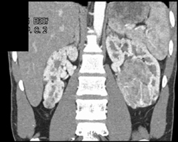 Multiple Bilateral Angiomyolipomas (AMLs) - CTisus CT Scan