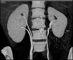 Duplicated System on the Right - CTisus CT Scan